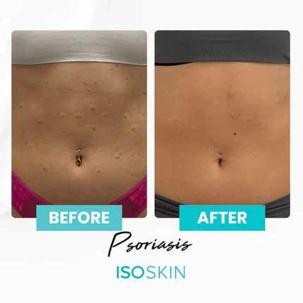 Isoclean Isoskin Hypochlorous Spray 100ml