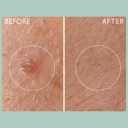 Lierac Anti-Blemish Protocol The Stop Spots 15ml